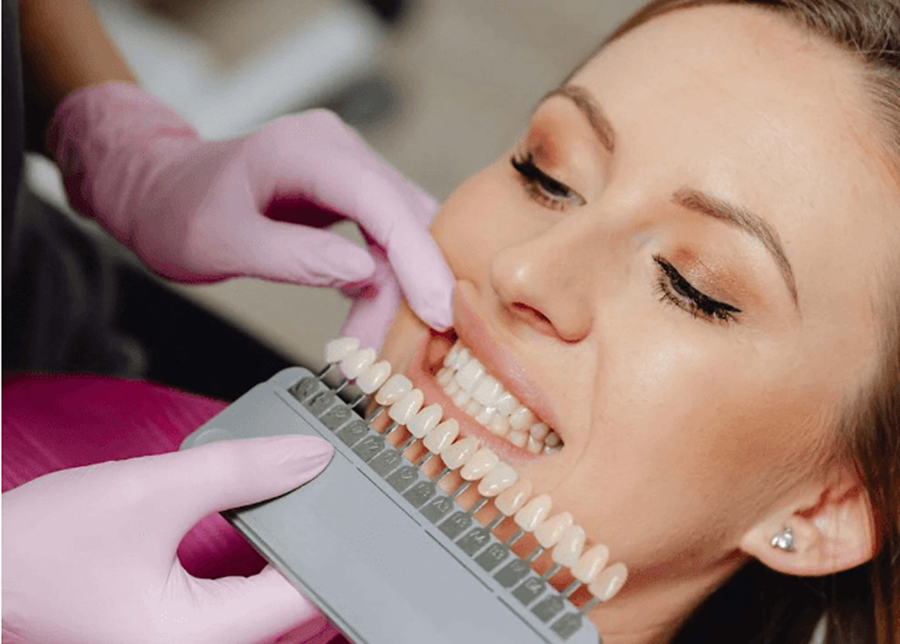 Teeth whitening comparison