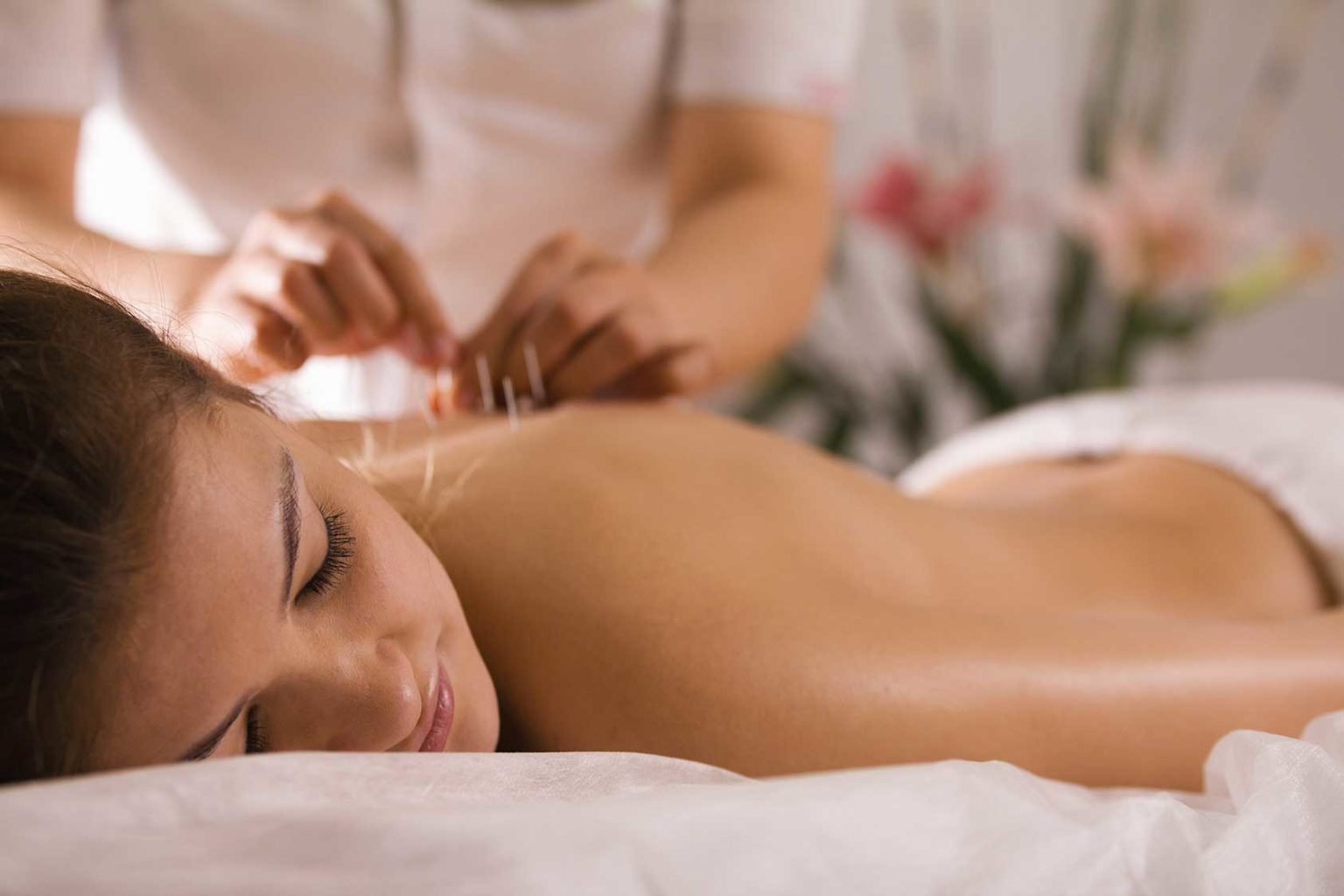 Women recieving acupuncture.